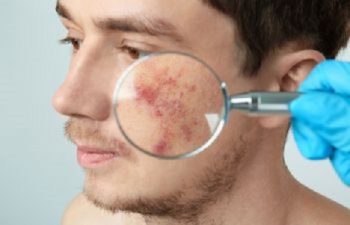 Young Man with Acne Being Examined