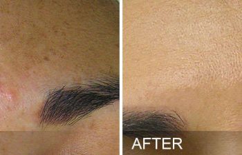 Hydrafacial brown spots before and after.