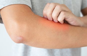 A person scratching their arm due to itchy skin.